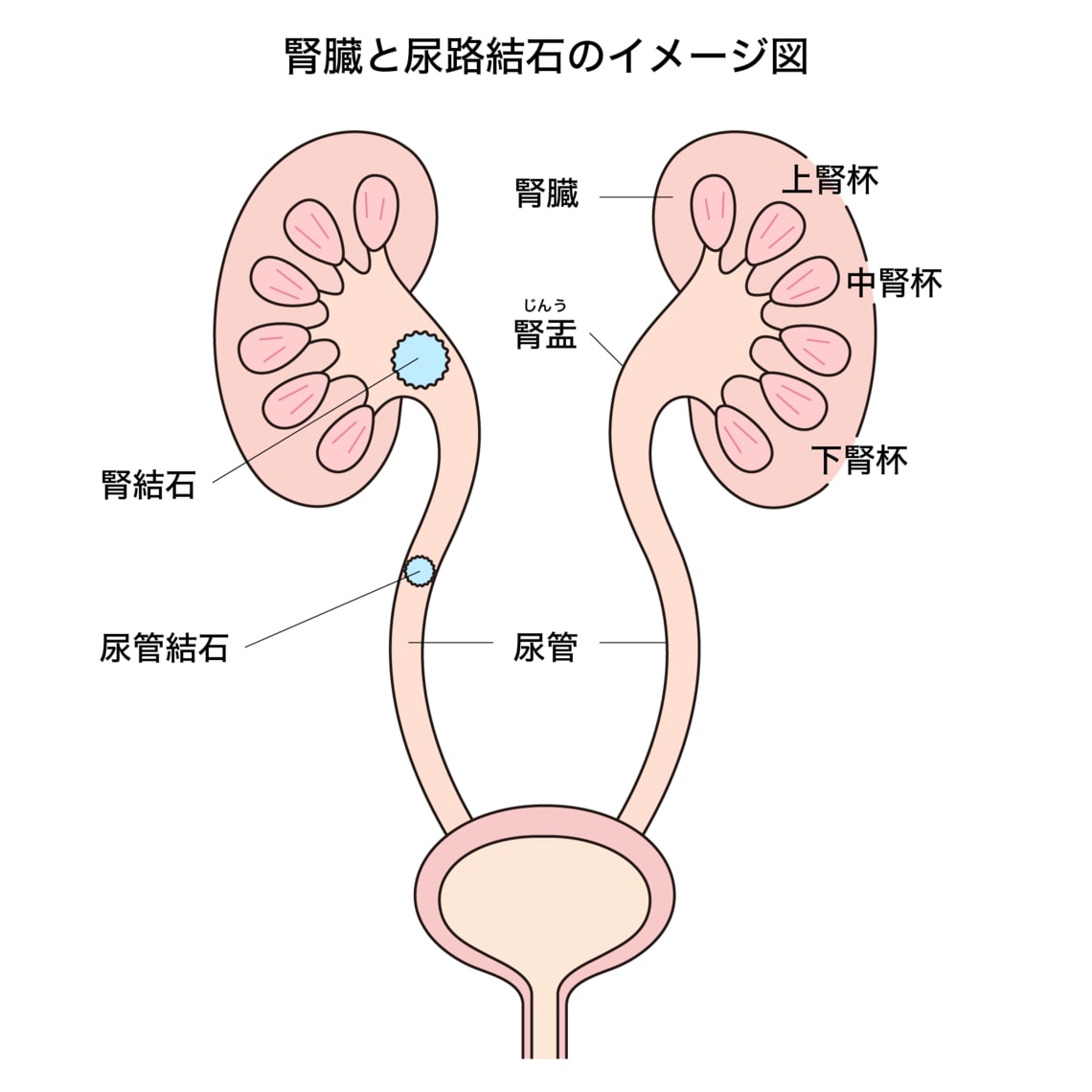 尿管結石腰の痛み – 腎臓が悪いと腰が痛くなる – JGRZNM