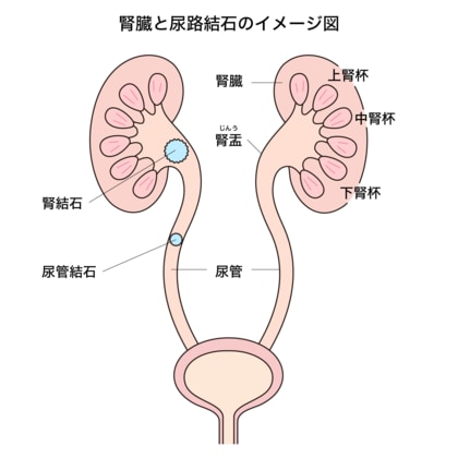 人類最強の痛み｣尿路結石症治療に新たな可能性 糖尿病治療薬に｢結石の