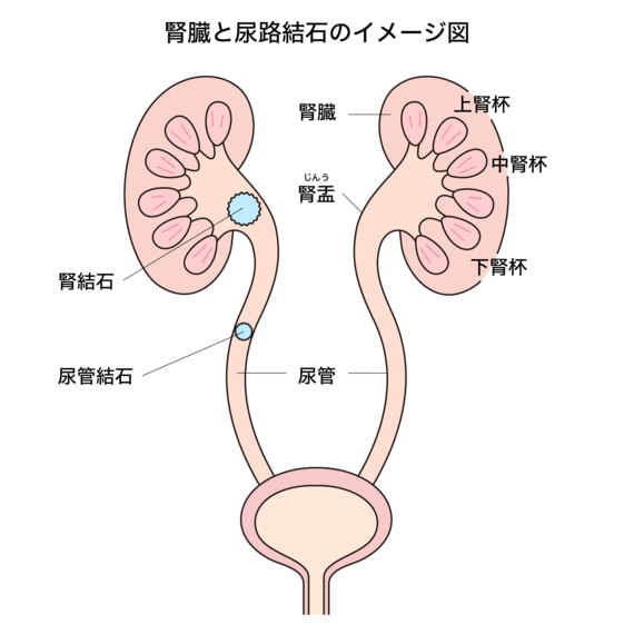 腎臓と尿路結石