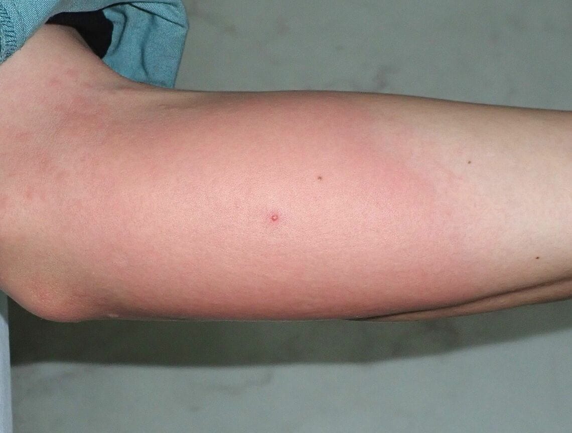 刺症例