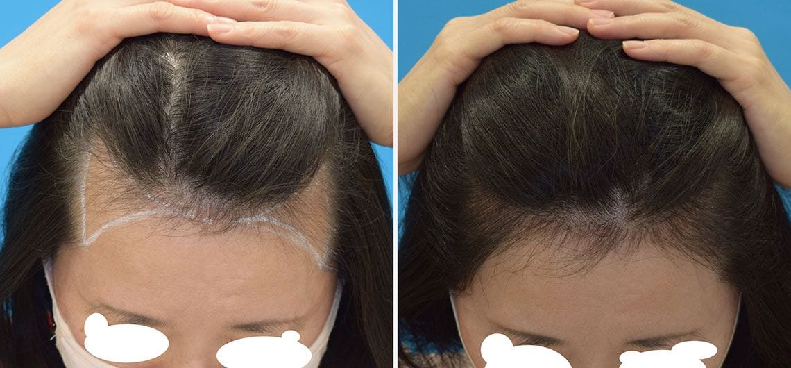 女性の自毛植毛の一例