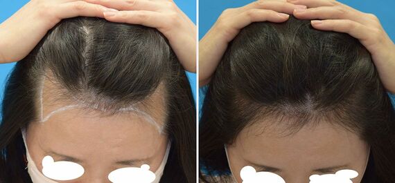 女性の自毛植毛の一例