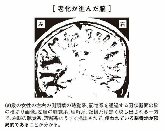 老化が進んだ脳の画像