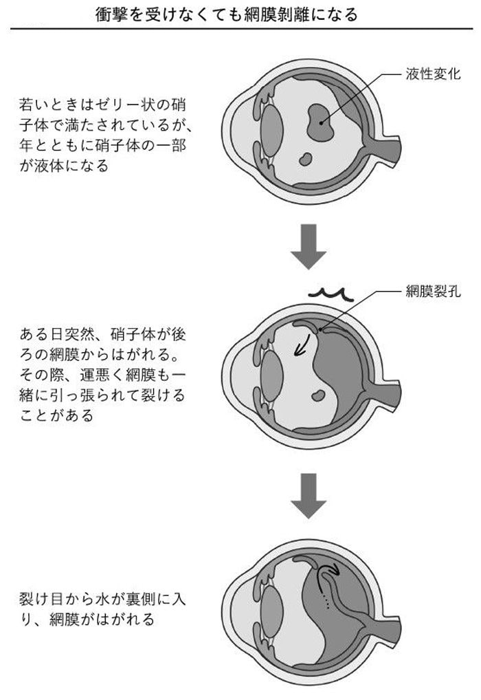 近視は病気です