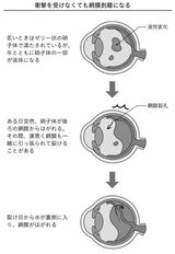 近視は病気です