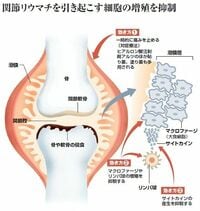 クスリの大図鑑 <関節リウマチ> 生物学的製剤の登場で痛みや腫れが“半減”