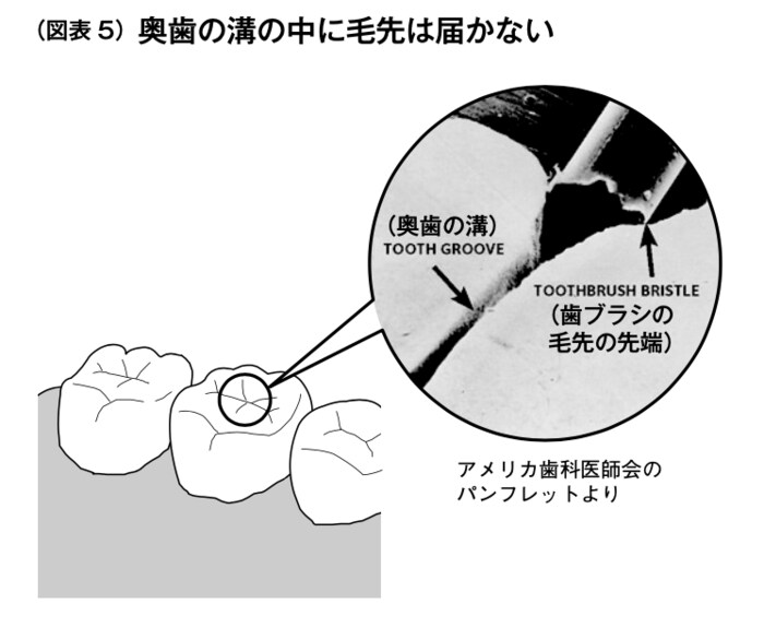 歯磨きに 虫歯を予防する効果はない 衝撃事実 健康 東洋経済オンライン 社会をよくする経済ニュース