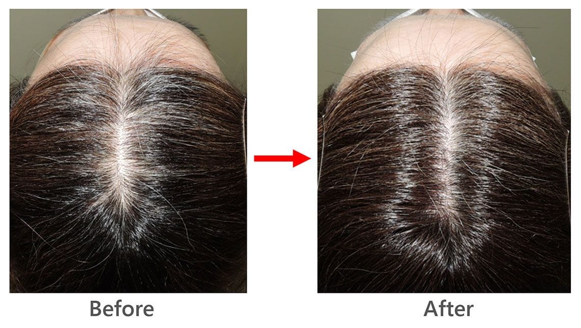 58歳女性の薄毛治療の症例