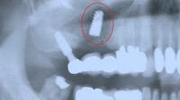 虫歯の人が妄信してしまう危険な歯科医5例