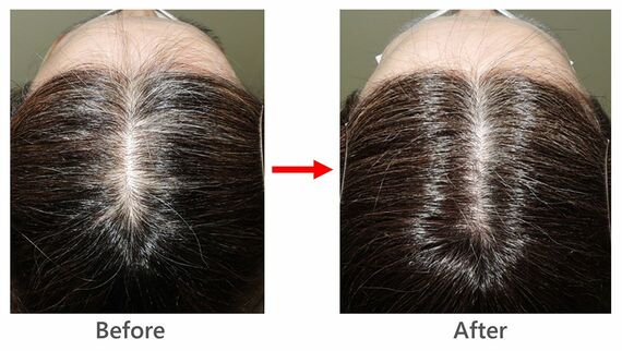 58歳女性の薄毛治療の症例