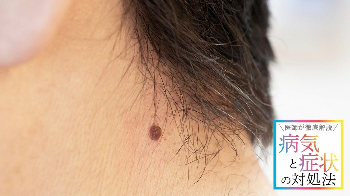 ホクロの安易なレーザー除去が危険な理由とは？（写真： symfonia ／PIXTA）