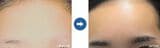 眉の自毛植毛の一例