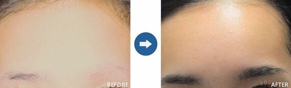 眉の自毛植毛の一例