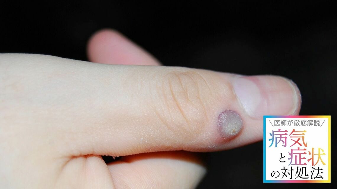 見た目も気になるイボ。見間違えるものの中には、がんの初期段階の可能性があるものも… …(写真:Hiroyuki / PIXTA)