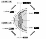 近視は病気です