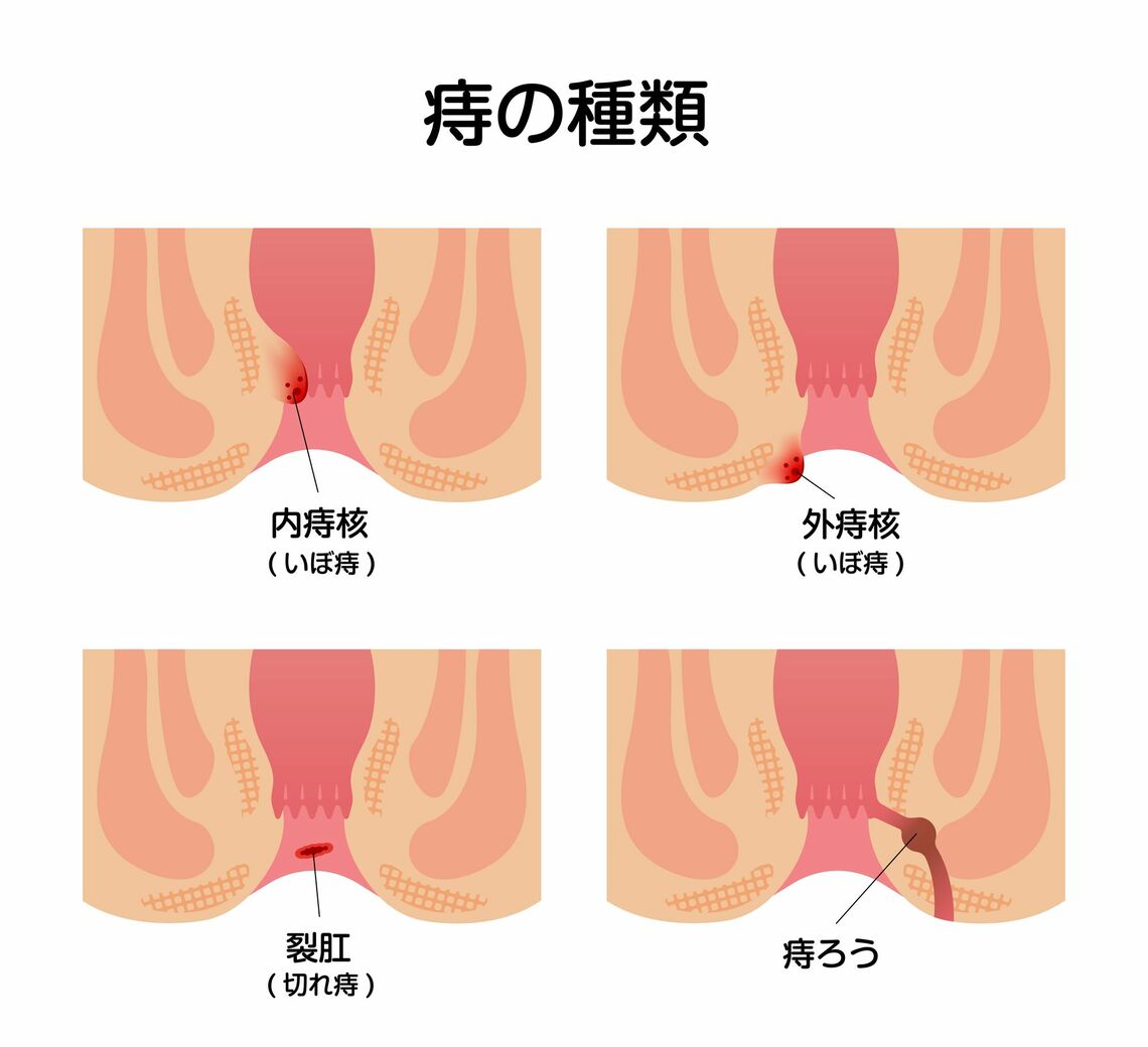 痔のタイプは全部で3つ（イラスト：barks／PIXTA）