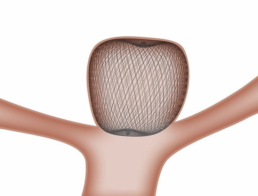 袋状塞栓デバイスの留置イメージ（画像：テルモ）