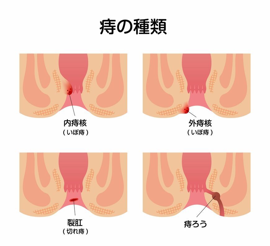 痔のタイプは全部で3つ（イラスト：barks／PIXTA）
