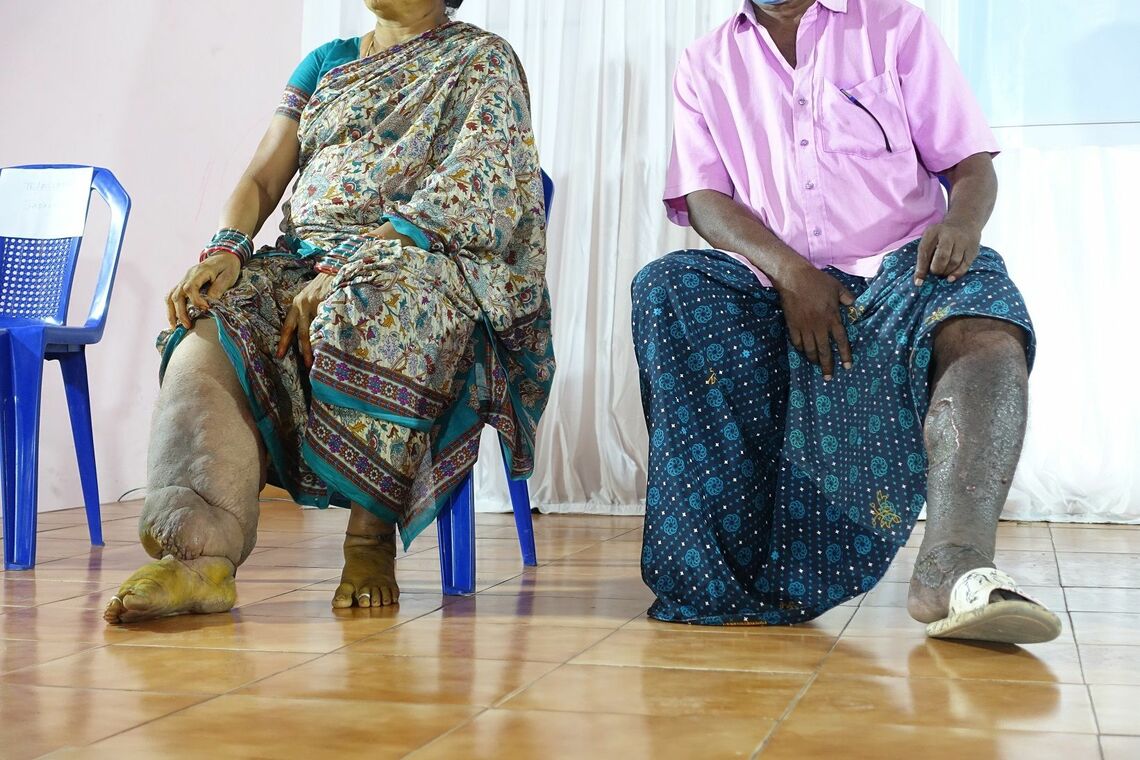 リンパ系フィラリア症の患者