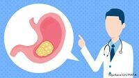 患者の6割が早期がん､手術が最も有効な治療法 PART3 6つのがんの徹底解説｜胃がん