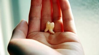 親知らずの抜歯､医師選びに役立つ3つの質問