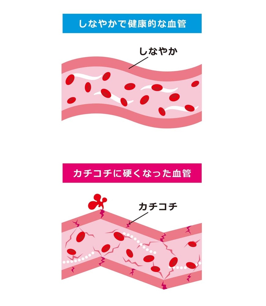 血管が柔らかければ血液の圧をうまく逃がすことができるが、血管が硬くなると突然死の危険性が高まる（画像：koti／PIXTA）