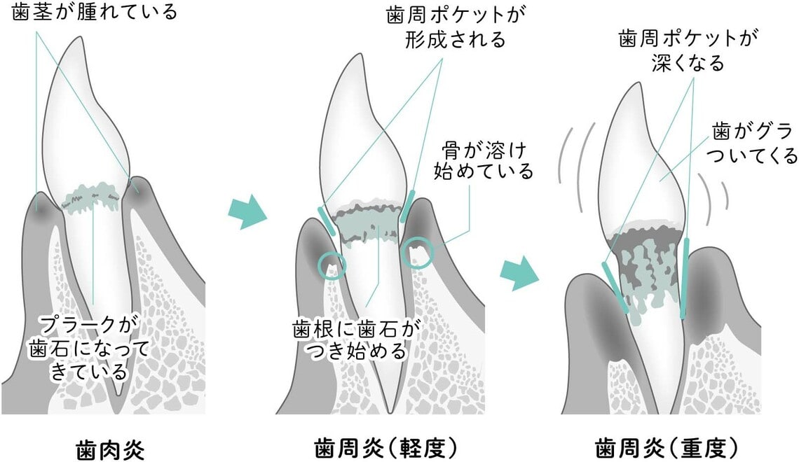 多くの人は歯周炎（重度）で初めて歯周病を自覚する（画像：『もう二度と歯医者の治療がいらなくなる3つの習慣 歯を失わないための本気の予防法』より）