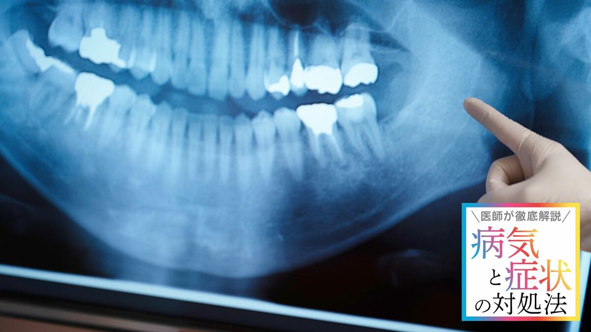 【歯周病】40代で5割も､｢きつい口臭｣には要注意 歯を失う原因の1位｢体質的な問題｣も明らかに | ｢病気｣と｢症状｣の対処法 | 東洋経済オンライン