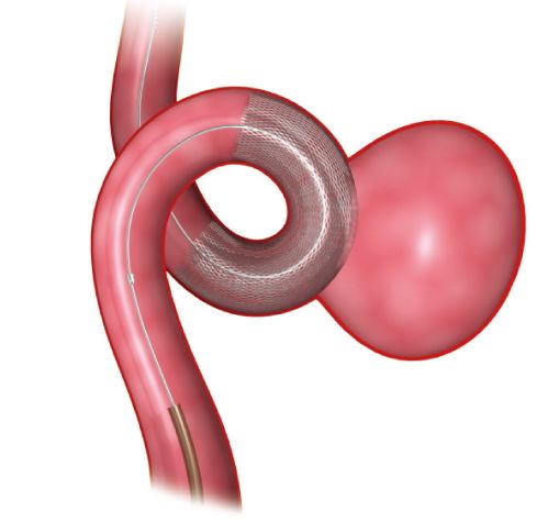 フローダイバーター留置術イメージ（画像：メドトロニック）