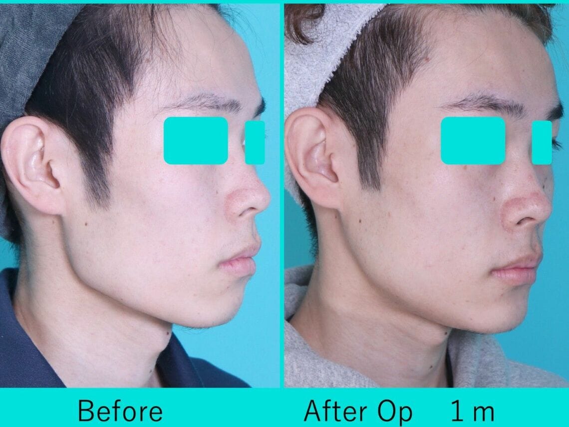 エラから顎先までの骨を切って整えるVライン形成を受けた10代男性（写真：銀座マイアミ美容外科提供）