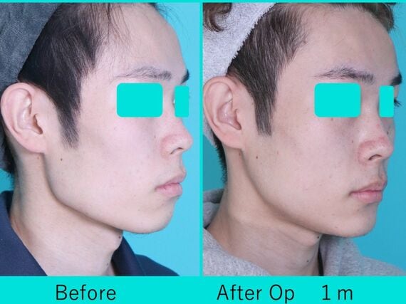 エラから顎先までの骨を切って整えるVライン形成を受けた10代男性（写真：銀座マイアミ美容外科提供）
