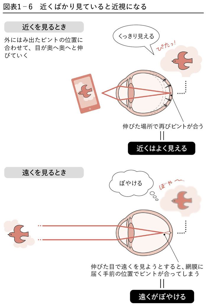 近視は病気です