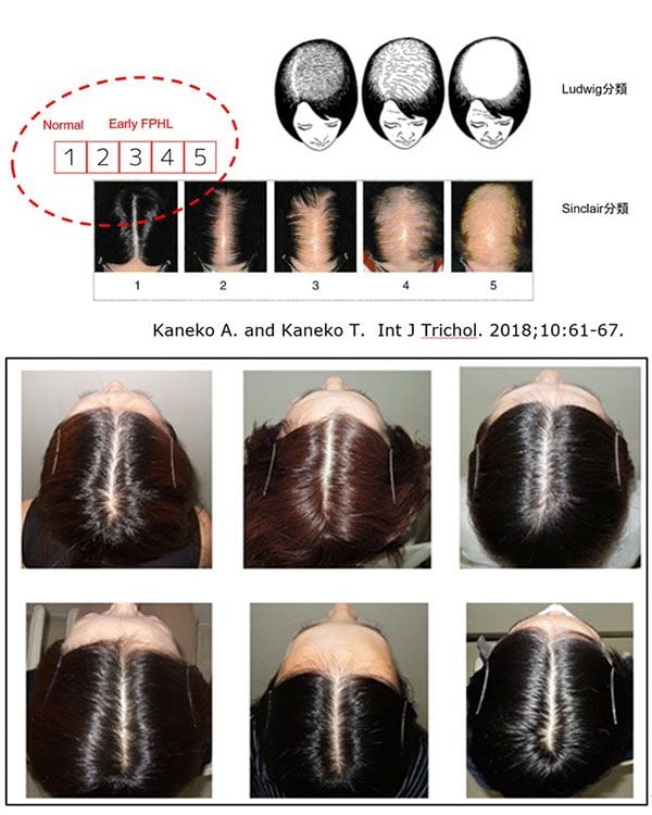 ルードヴィヒ分類・シンクレア分類とシンクレア分類