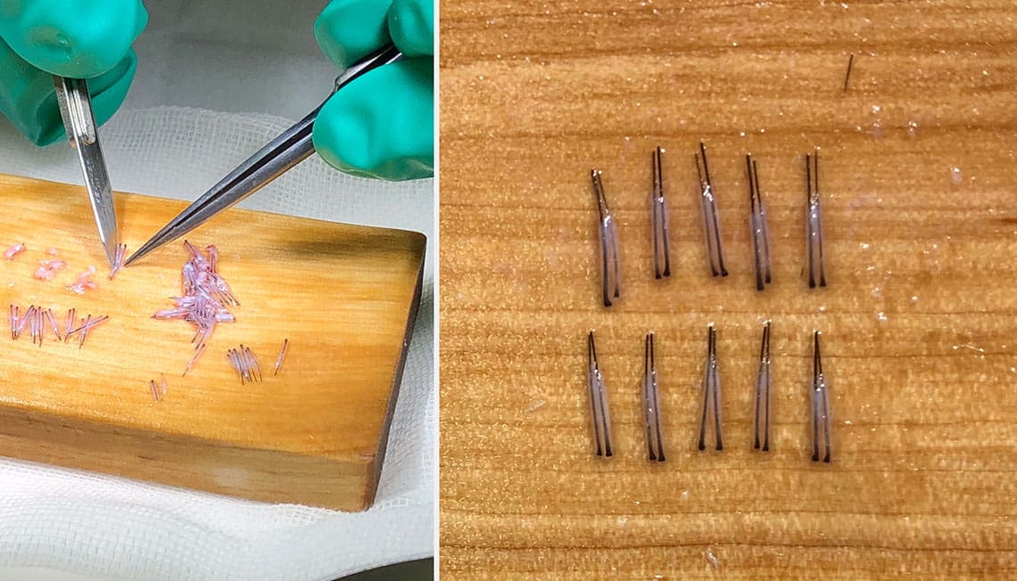 移植元の後頭部から取り出したドナーとなる自毛の毛包と植毛用に2本ずつに株分けして整えたもの