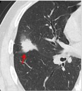 肺がんのCT画像。矢印の先にある「がん」（画像：株式会社ワイズ・リーディング提供）