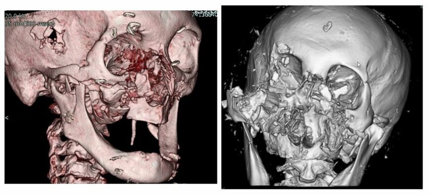 顔の骨が折れた患者さんの3D-CT画像（画像：中永さん提供）