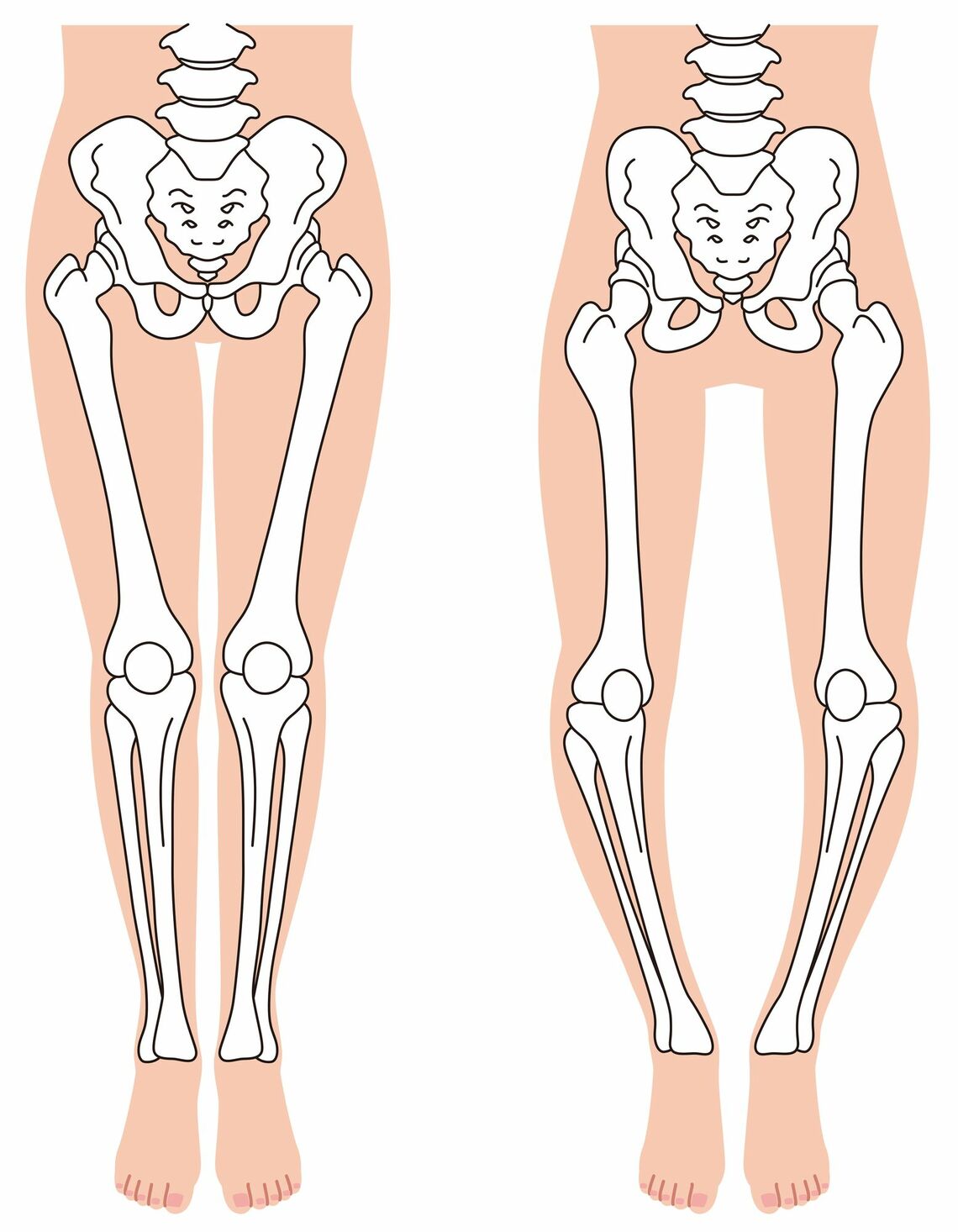 正常な膝関節（左）では膝の軟骨に均等に負担がかかるが、外反膝（右）になると膝関節内部の内側にかかる圧力が高まって軟骨がすり減りやすい（イラスト：koti／PIXTA）