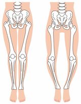 正常な膝関節（左）では膝の軟骨に均等に負担がかかるが、外反膝（右）になると膝関節内部の内側にかかる圧力が高まって軟骨がすり減りやすい（イラスト：koti／PIXTA）