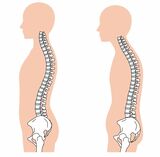 正常な姿勢では頸椎と腰椎が前弯、中央の胸椎が後弯するS字状のカーブを描いている（左）。猫背（腰椎後弯症）は頸椎と腰椎の前弯が失われ、胸椎の後弯が強くなった状態（イラスト：koti／PIXTA）