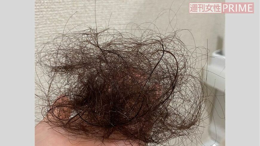 脱け毛の量は普段の3倍になったという（写真：鈴木さん提供）