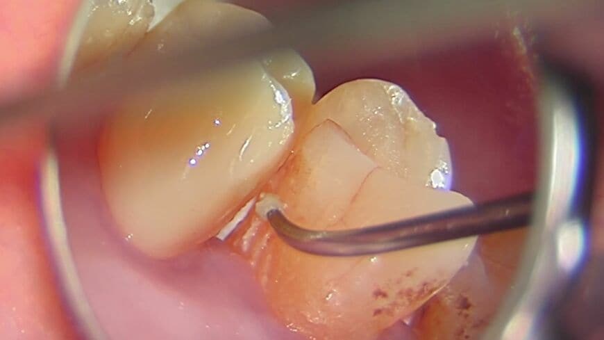 表示回数441万回の「歯垢除去動画」から（画像：吉田さん提供）