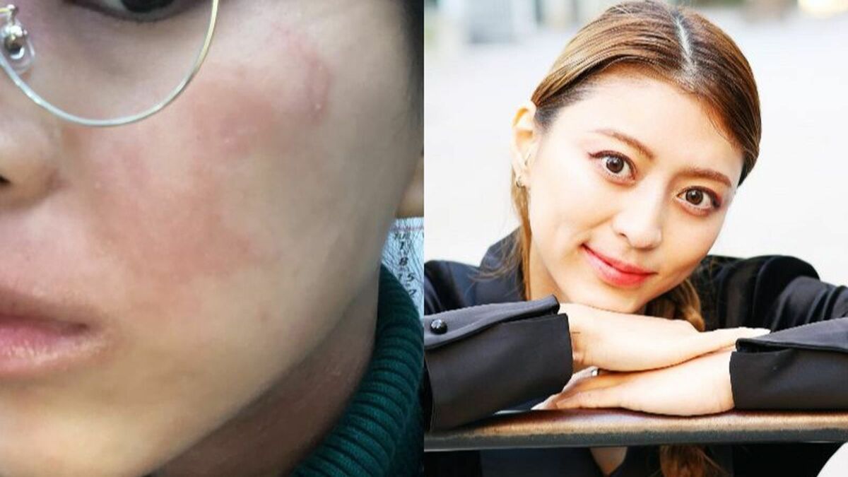 アトピー肌の29歳女性「人前で水着に」激変のワケ | 筋トレ社会人のキャリア論 | 東洋経済オンライン