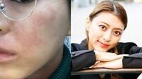 ｢アトピーで肌が真っ赤｣｢写真に映るのも苦手だった｣のに今や人前で水着に！　美ボディ競う大会で準優勝､29歳彼女に起きた3つの"大変化"
