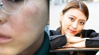 アトピー肌の29歳女性｢人前で水着に｣激変のワケ