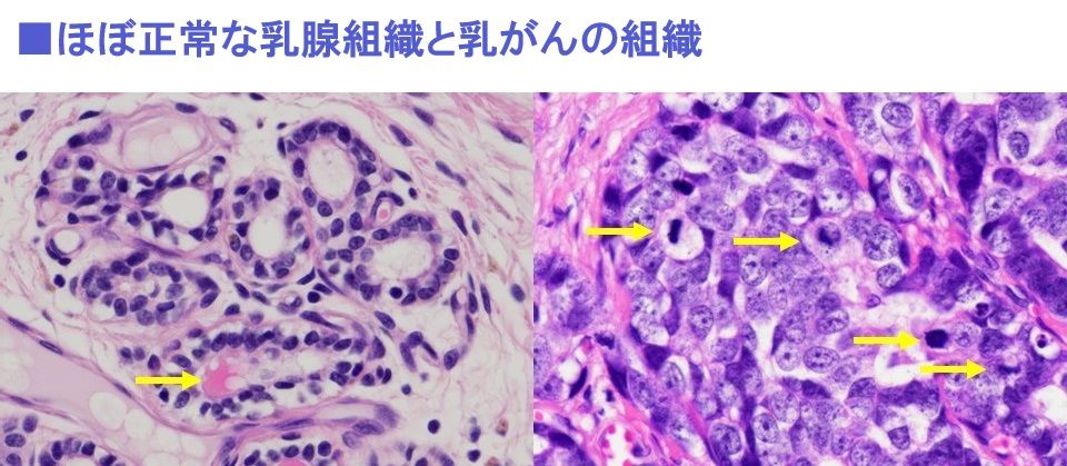 左はほぼ正常な乳腺組織。矢印で示している真ん中の空所に分泌された乳汁が見える。右はがん細胞。正常な構造から大きく逸脱したがん細胞が増えている。矢印はがん細胞が活発に分裂している様子（顕微鏡写真：中村進一提供）