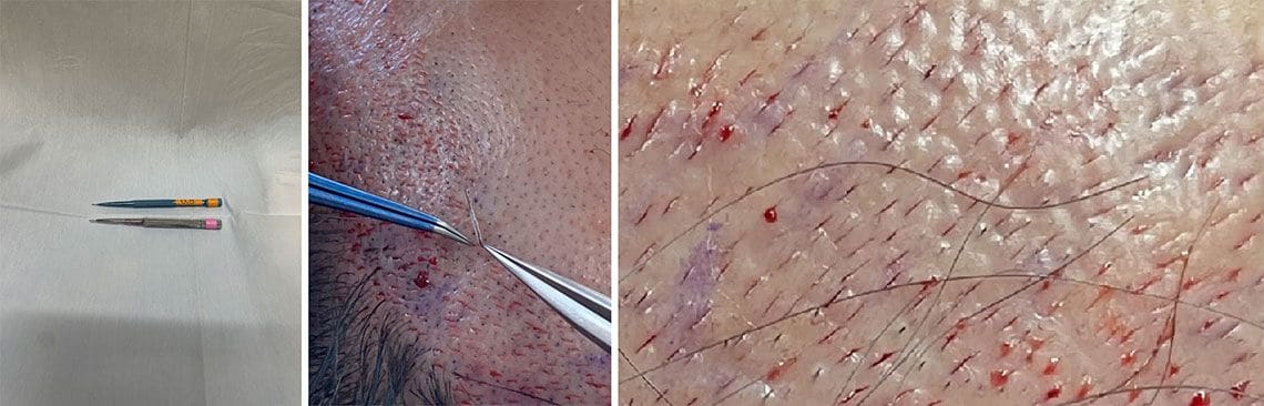 イン状の毛穴（ラインスリット）を切開して作るためのマイクロブレード／移植している様子とその後
