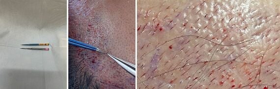 イン状の毛穴（ラインスリット）を切開して作るためのマイクロブレード／移植している様子とその後