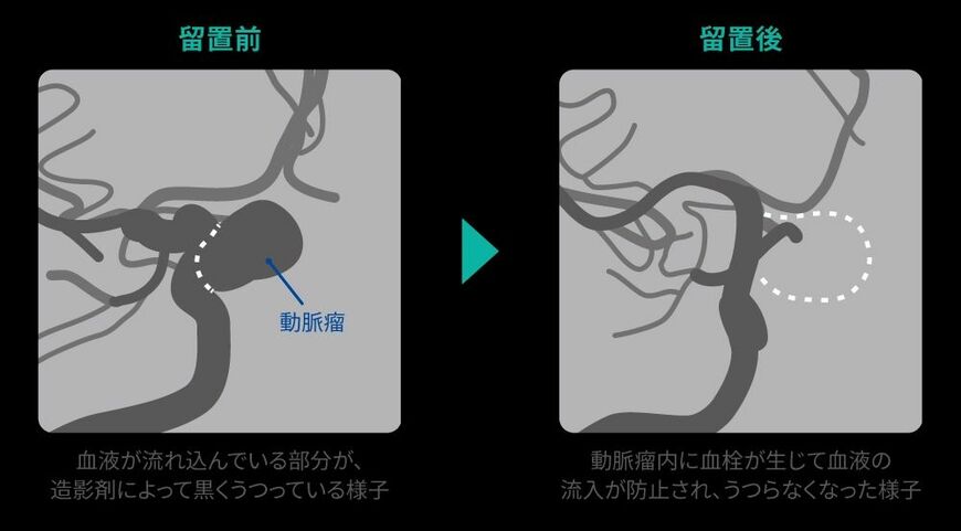 フローダイバーター留置前と留置後の比較（画像：メドトロニック）