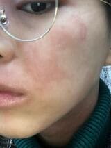 筋トレを始める前は、アトピー肌に悩まされてきた（写真：本人提供）