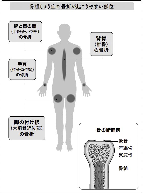 骨粗しょう症で骨折が起こりやすい部位